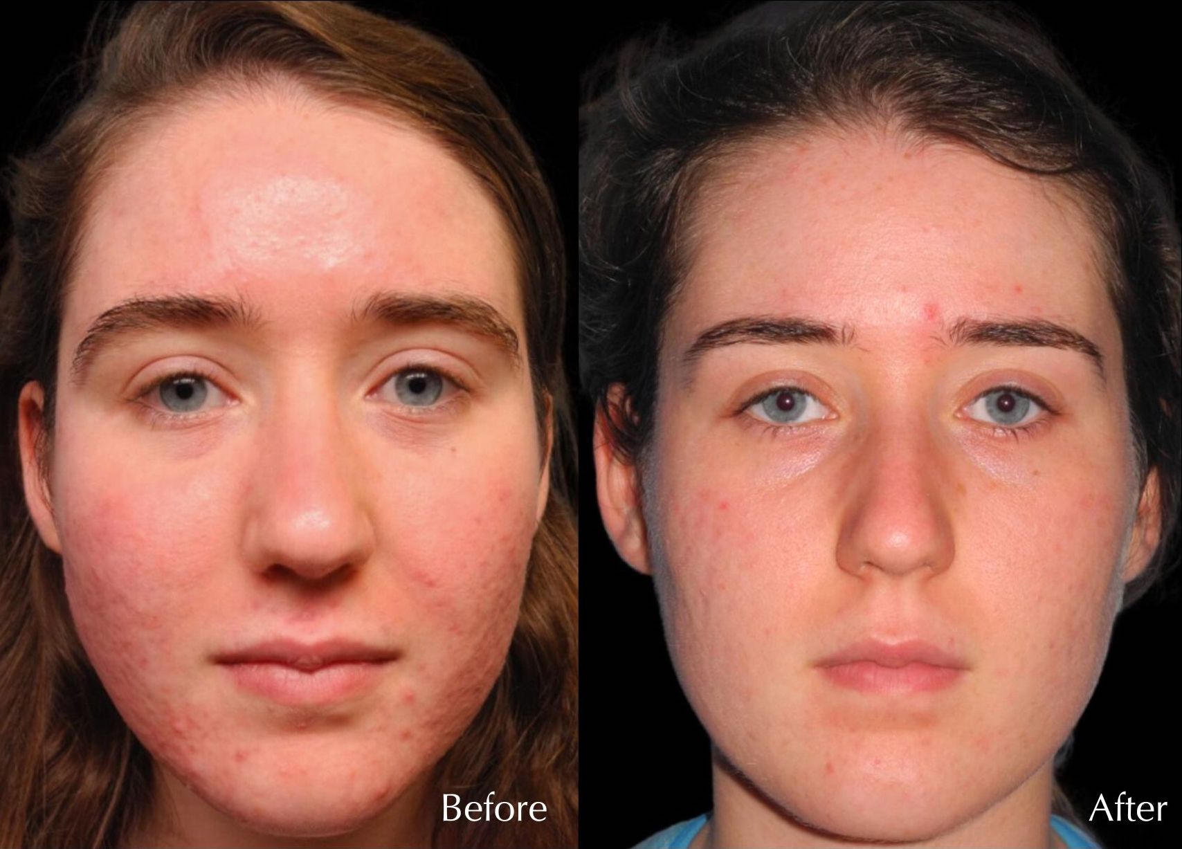 Before and After Acne Treatment at Chernoff Cosmetic Surgery