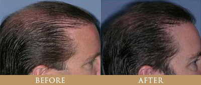 hair-transplantation-01a-thumb