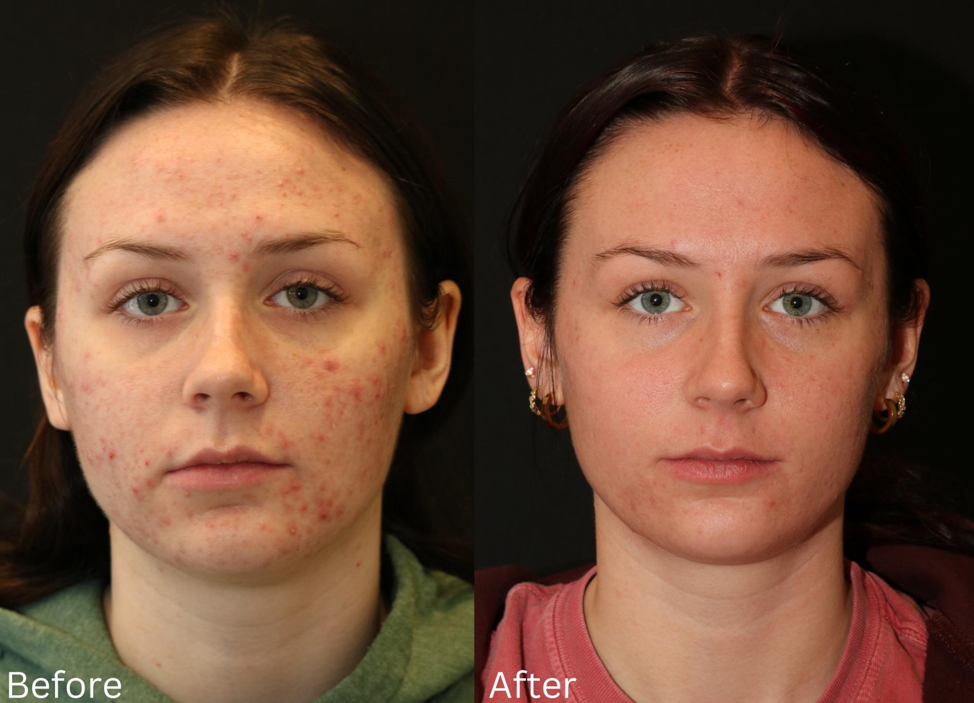 Indianapolis Acne Treatment Chernoff