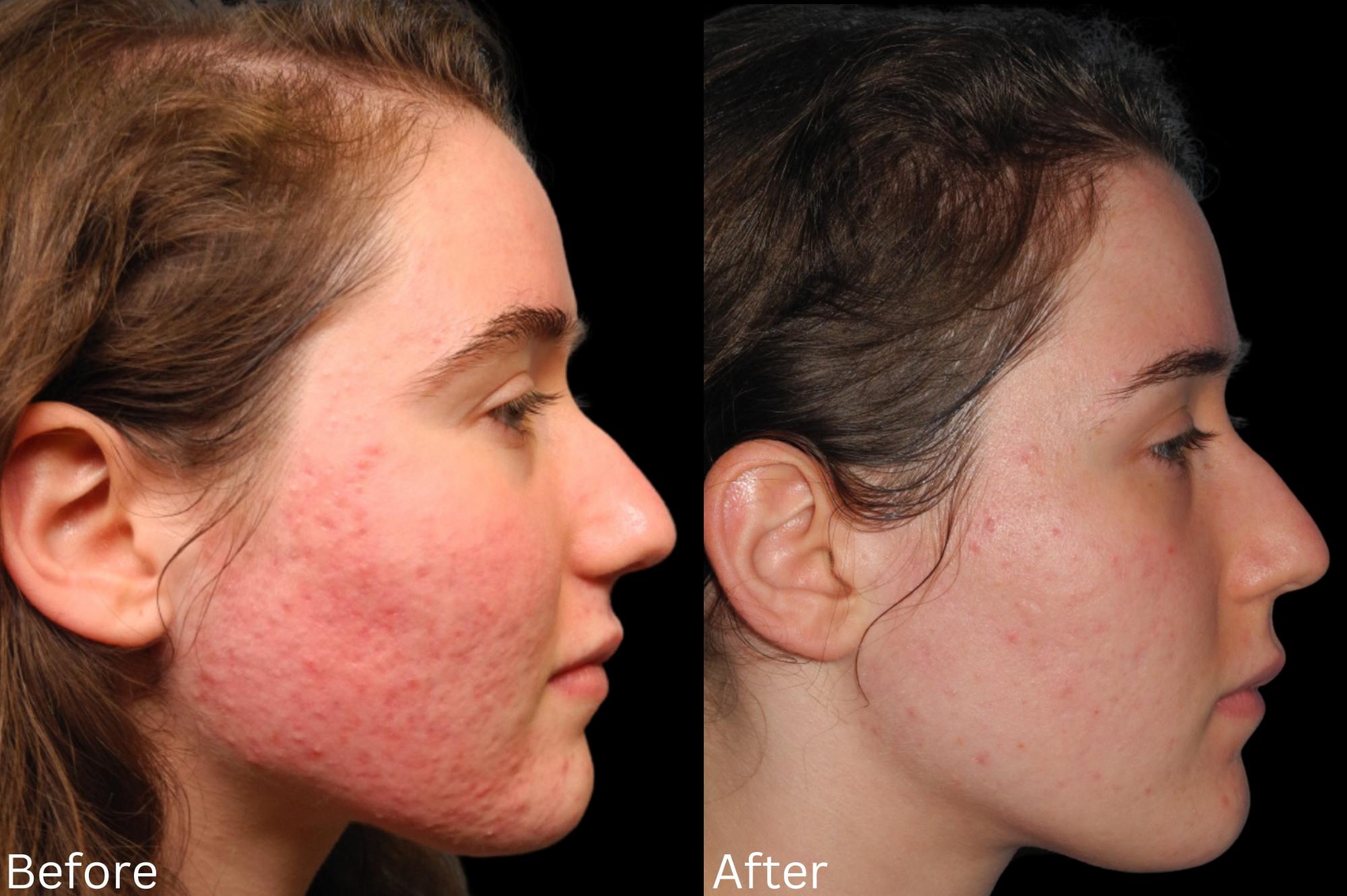 Indianapolis Acne Treatment Chernoff