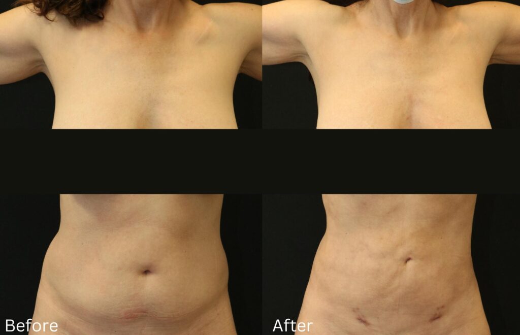 BodyTite1A