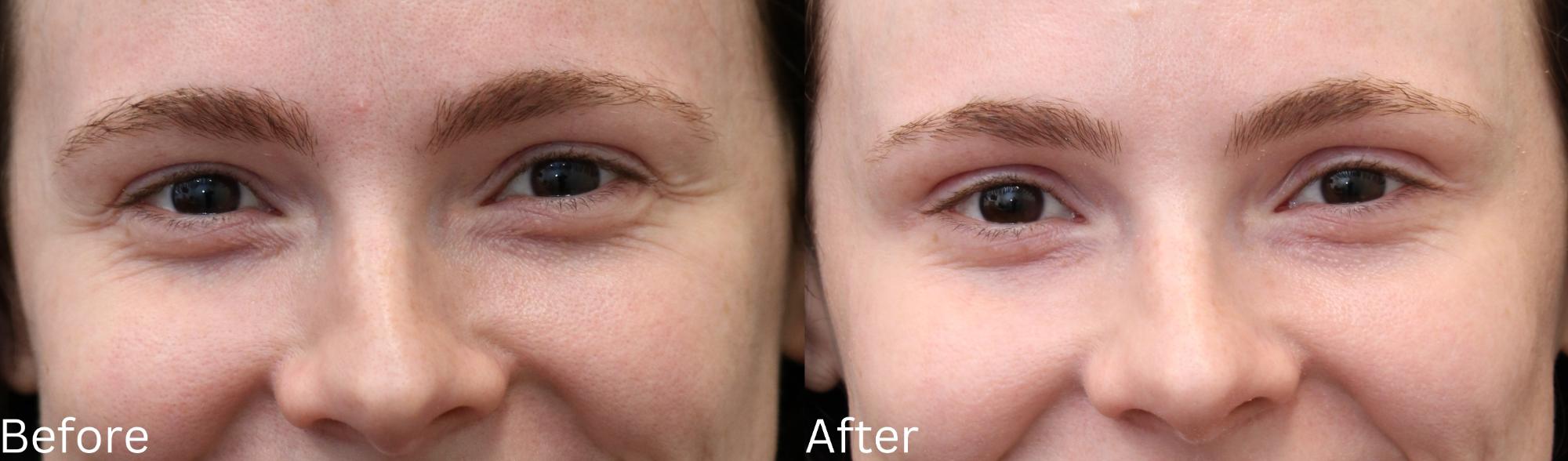 Indianapolis Botox Chernoff