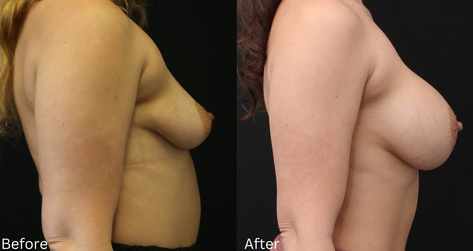Indianapolis breast augmentation chernoff