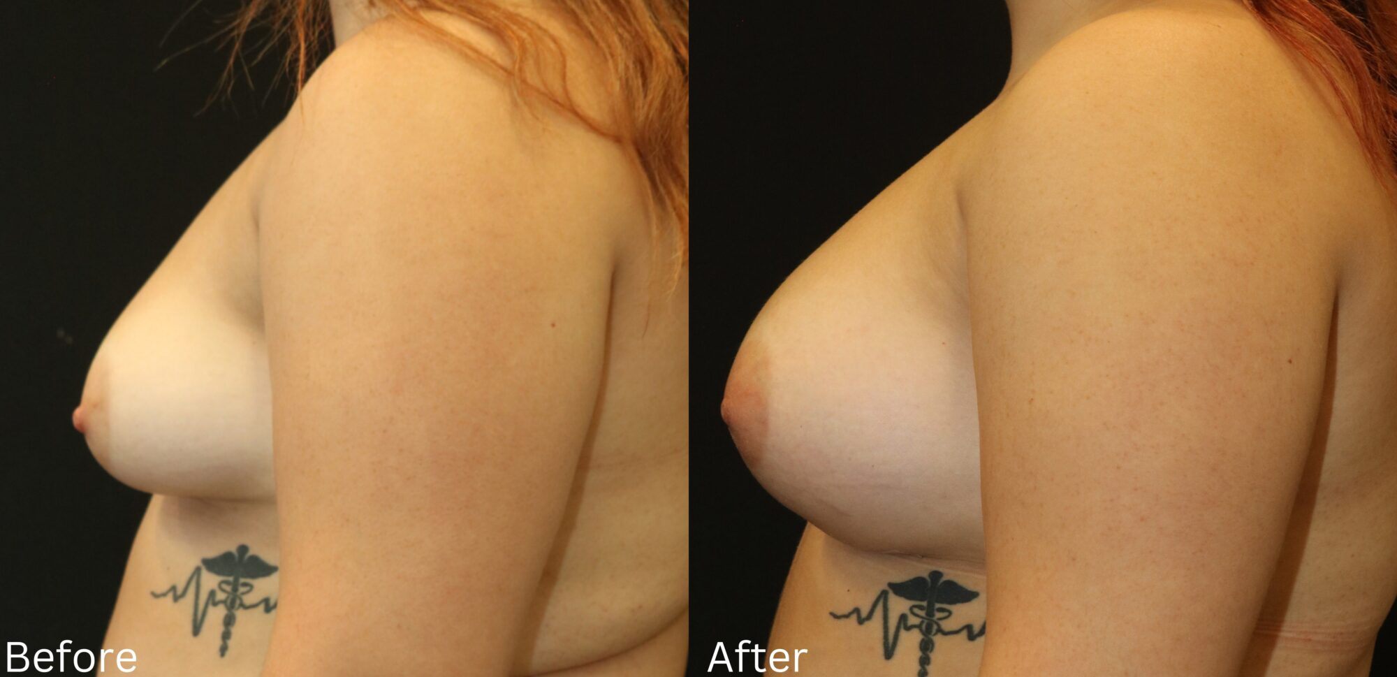 Indianapolis breast augmentation chernoff