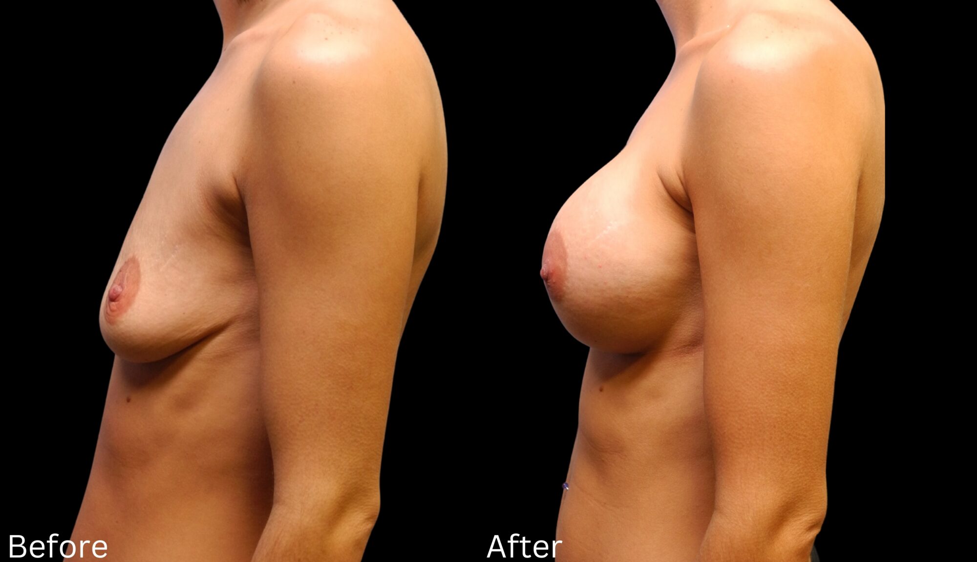 Indianapolis breast augmentation chernoff