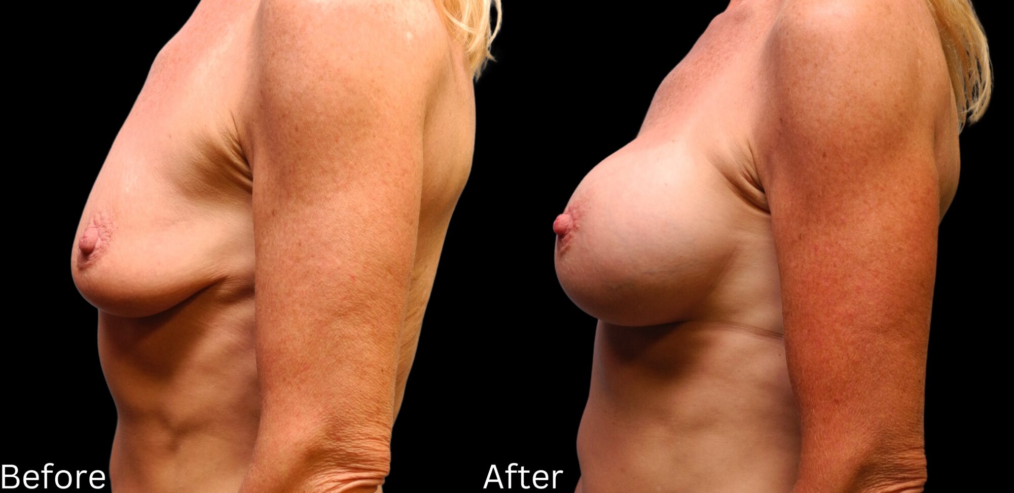 Indianapolis breast augmentation chernoff