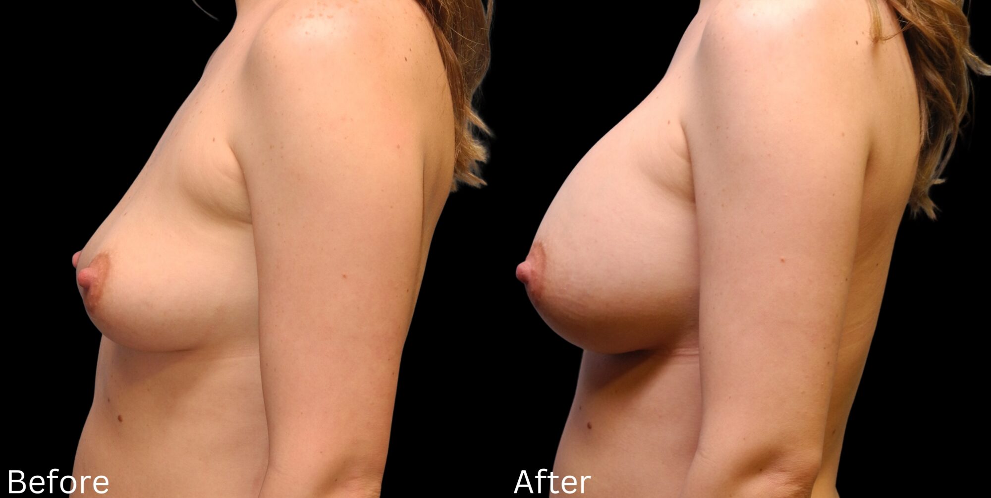 Indianapolis breast augmentation chernoff