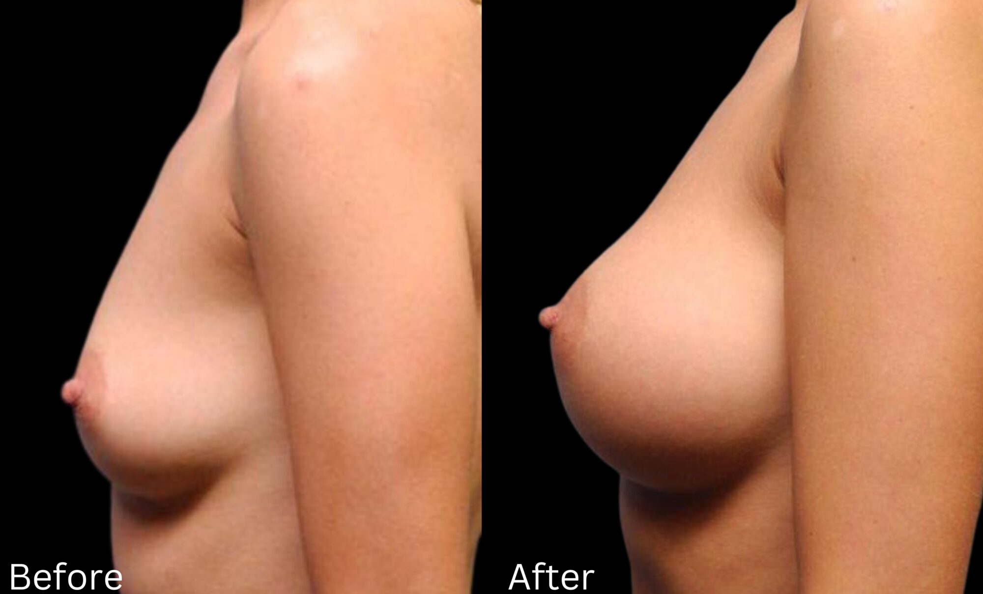 Indianapolis breast augmentation chernoff