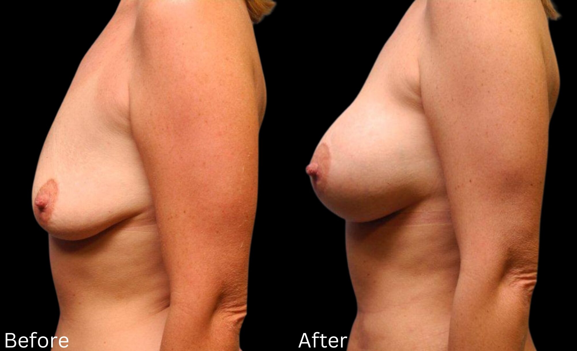 Indianapolis breast augmentation chernoff