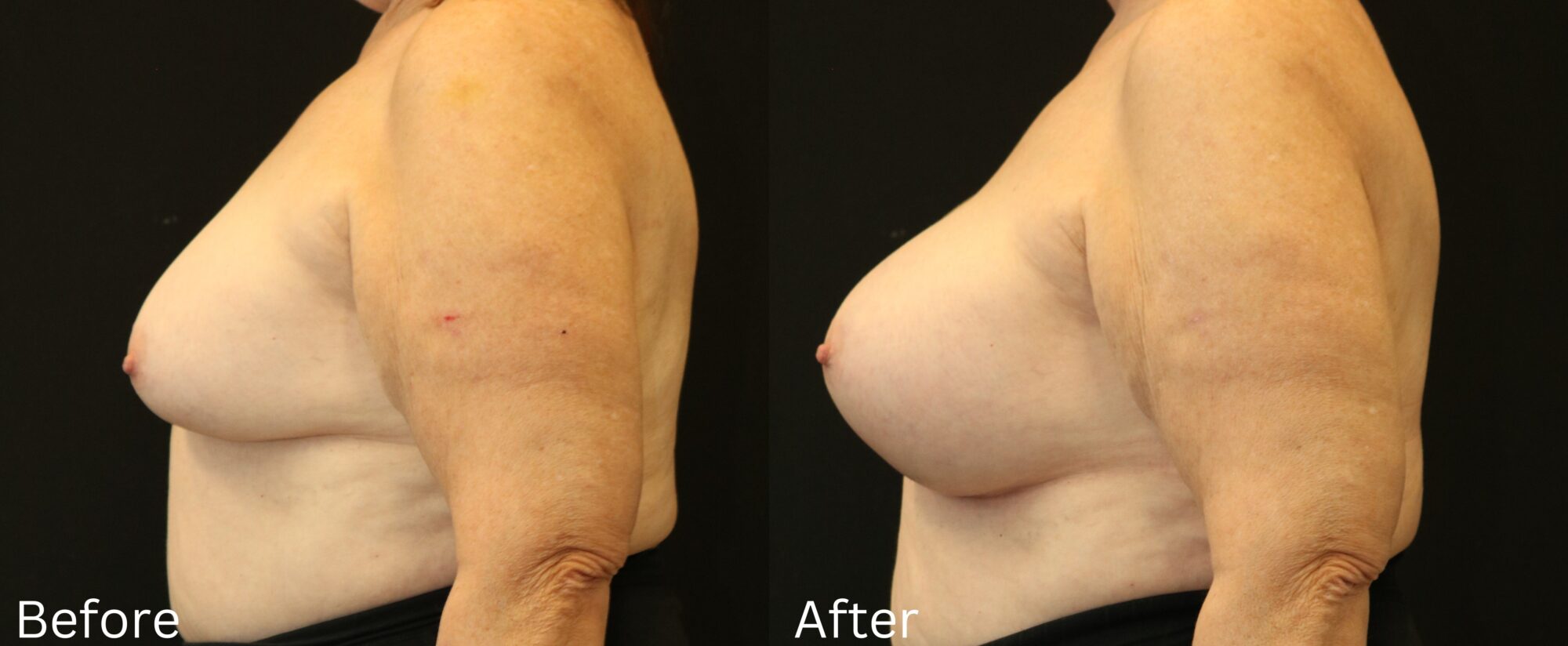 Indianapolis breast augmentation chernoff