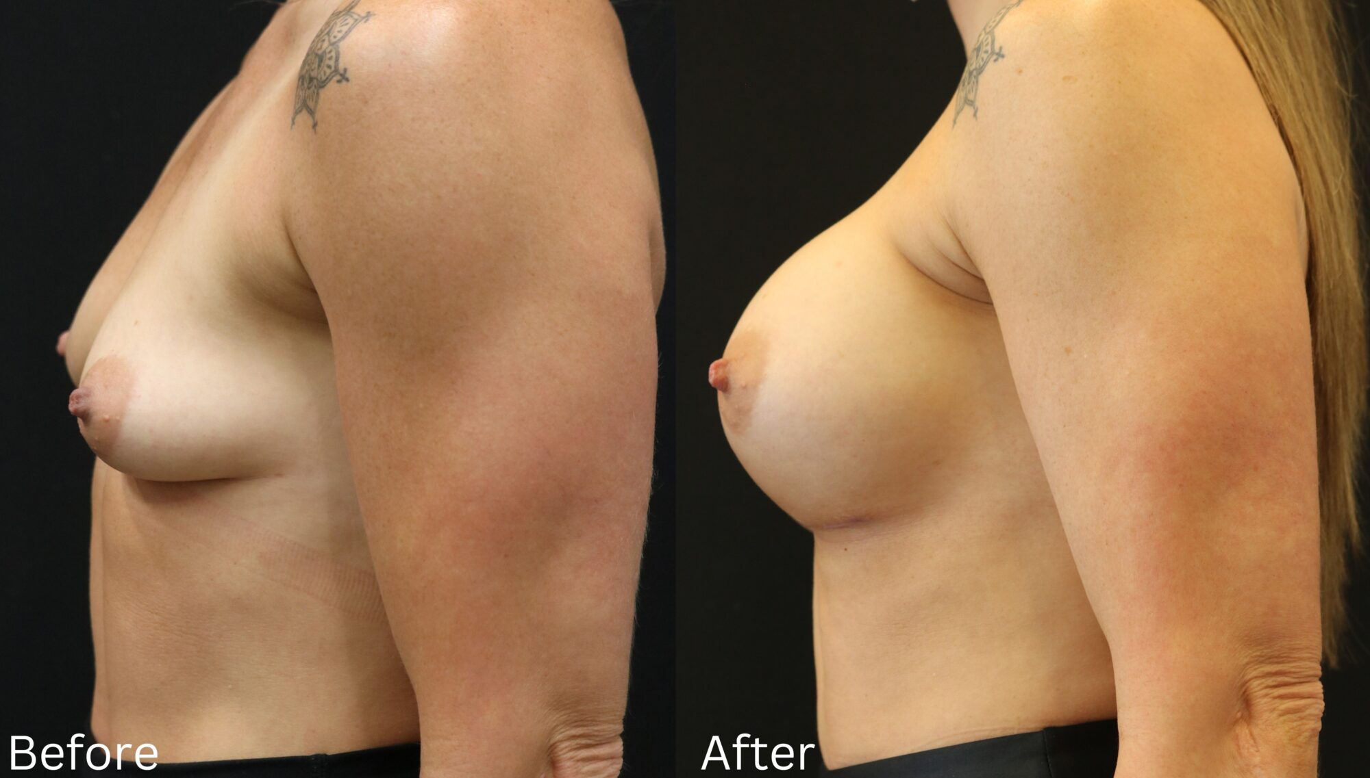 Indianapolis breast augmentation chernoff