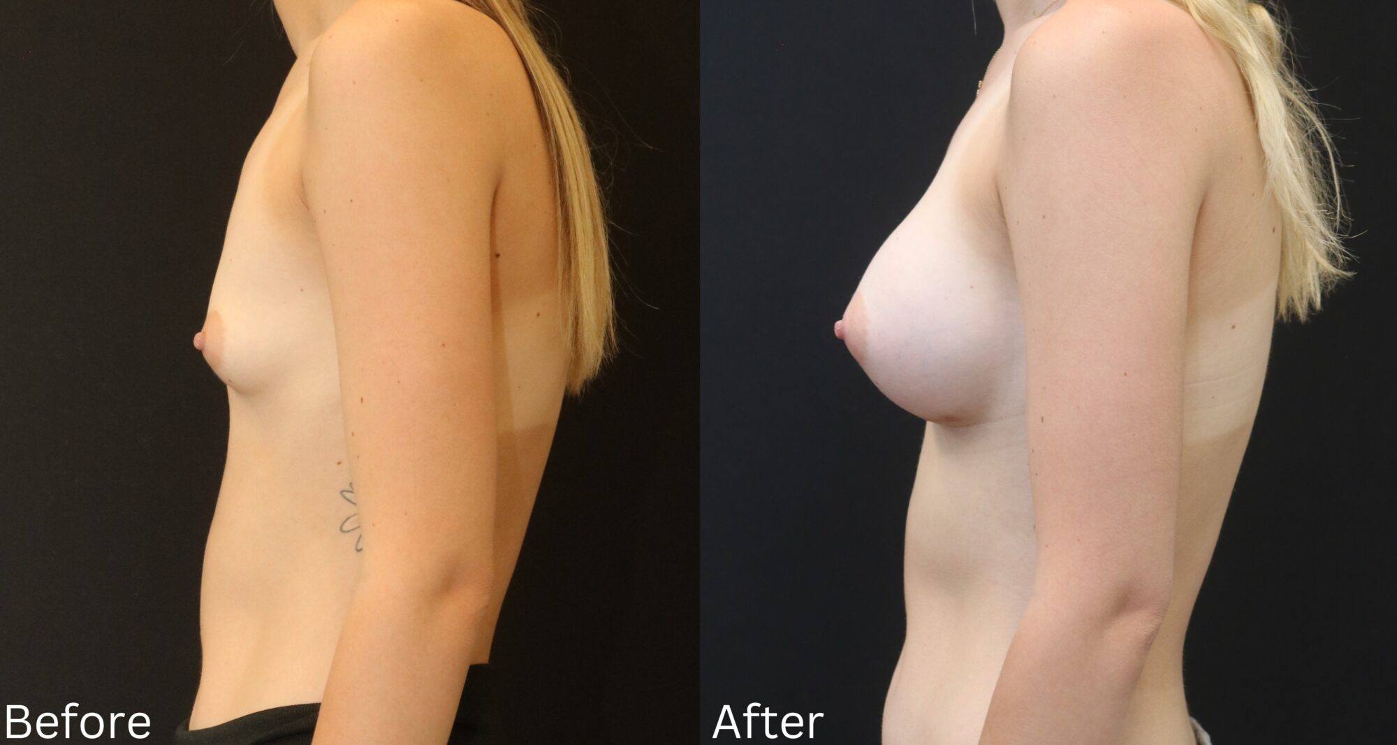 Indianapolis breast augmentation chernoff