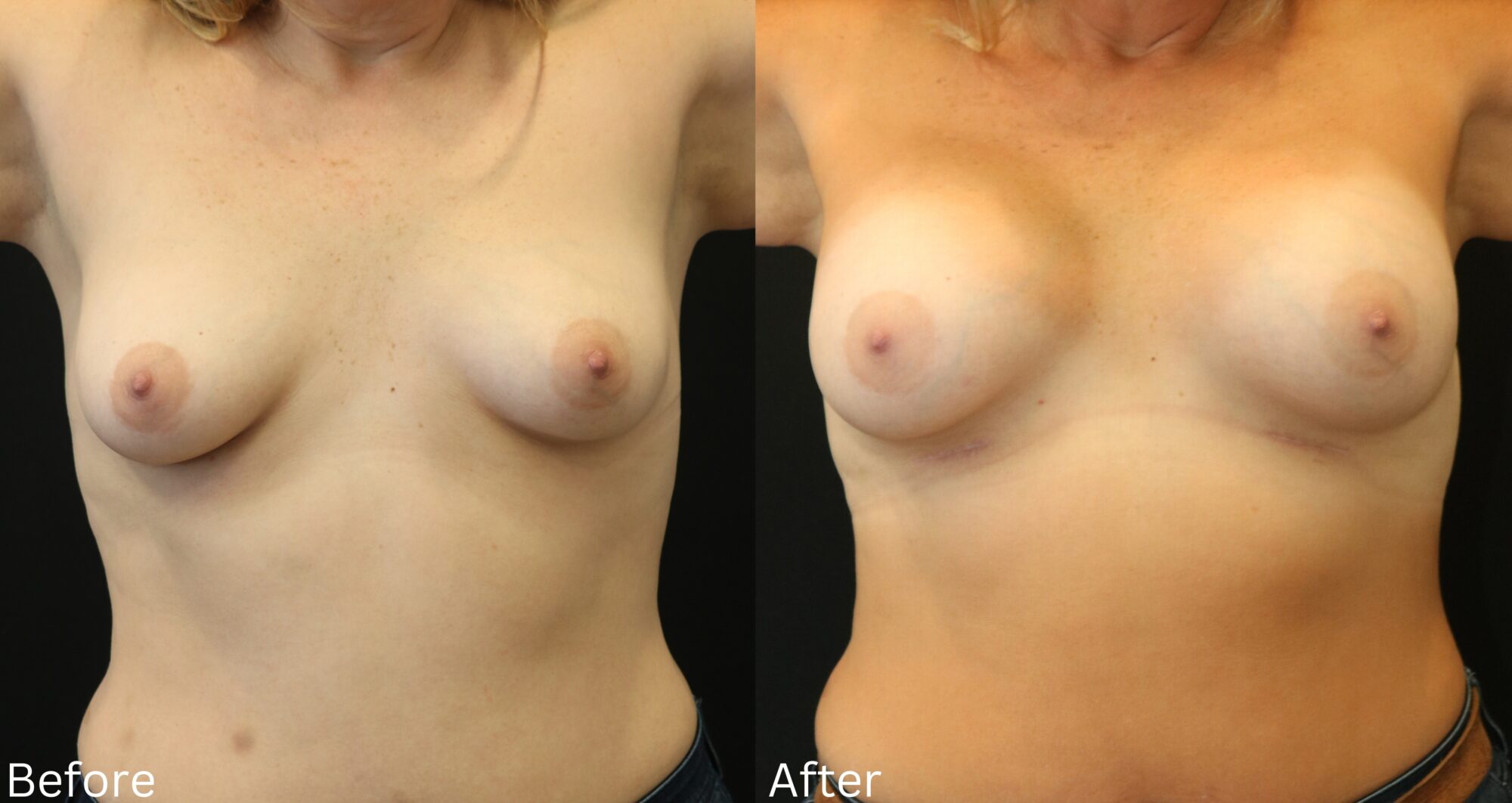 Indianapolis breast augmentation chernoff