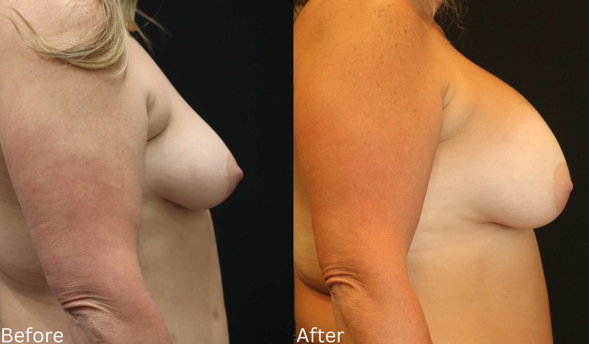Indianapolis breast augmentation chernoff