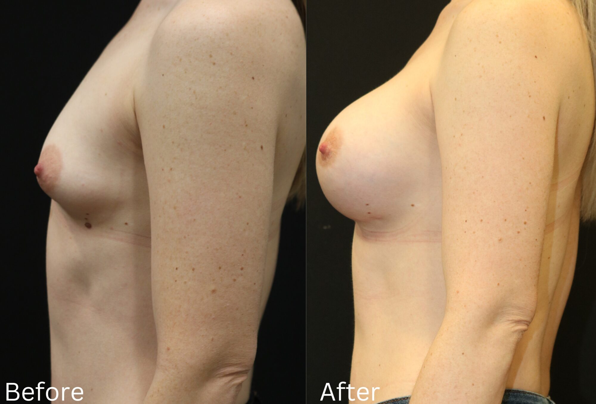 Indianapolis breast augmentation chernoff