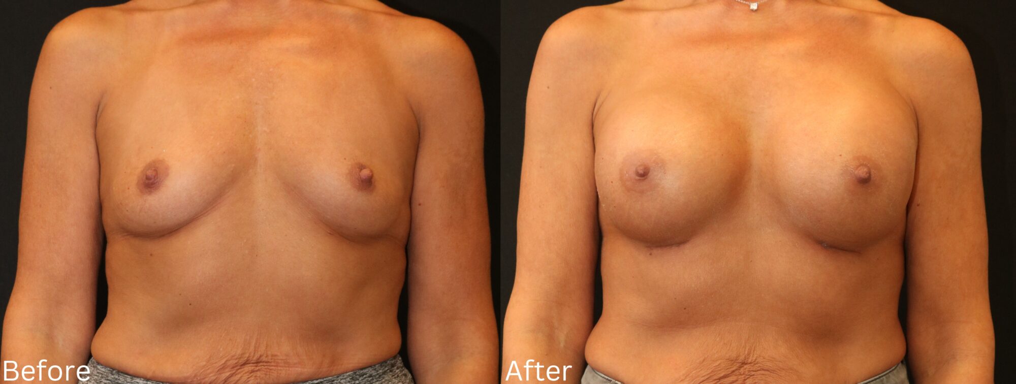 Indianapolis breast augmentation chernoff