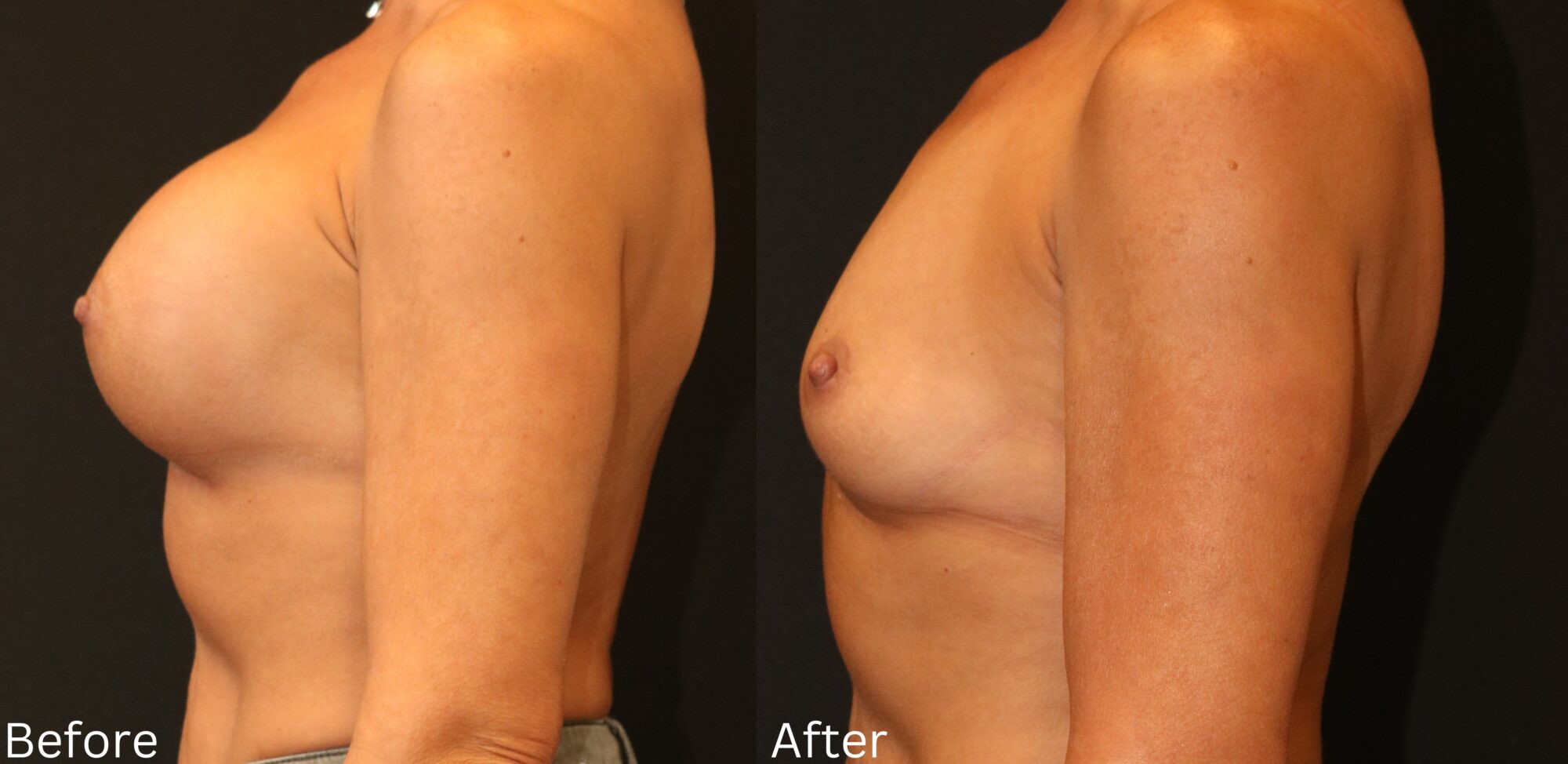 Indianapolis breast augmentation chernoff