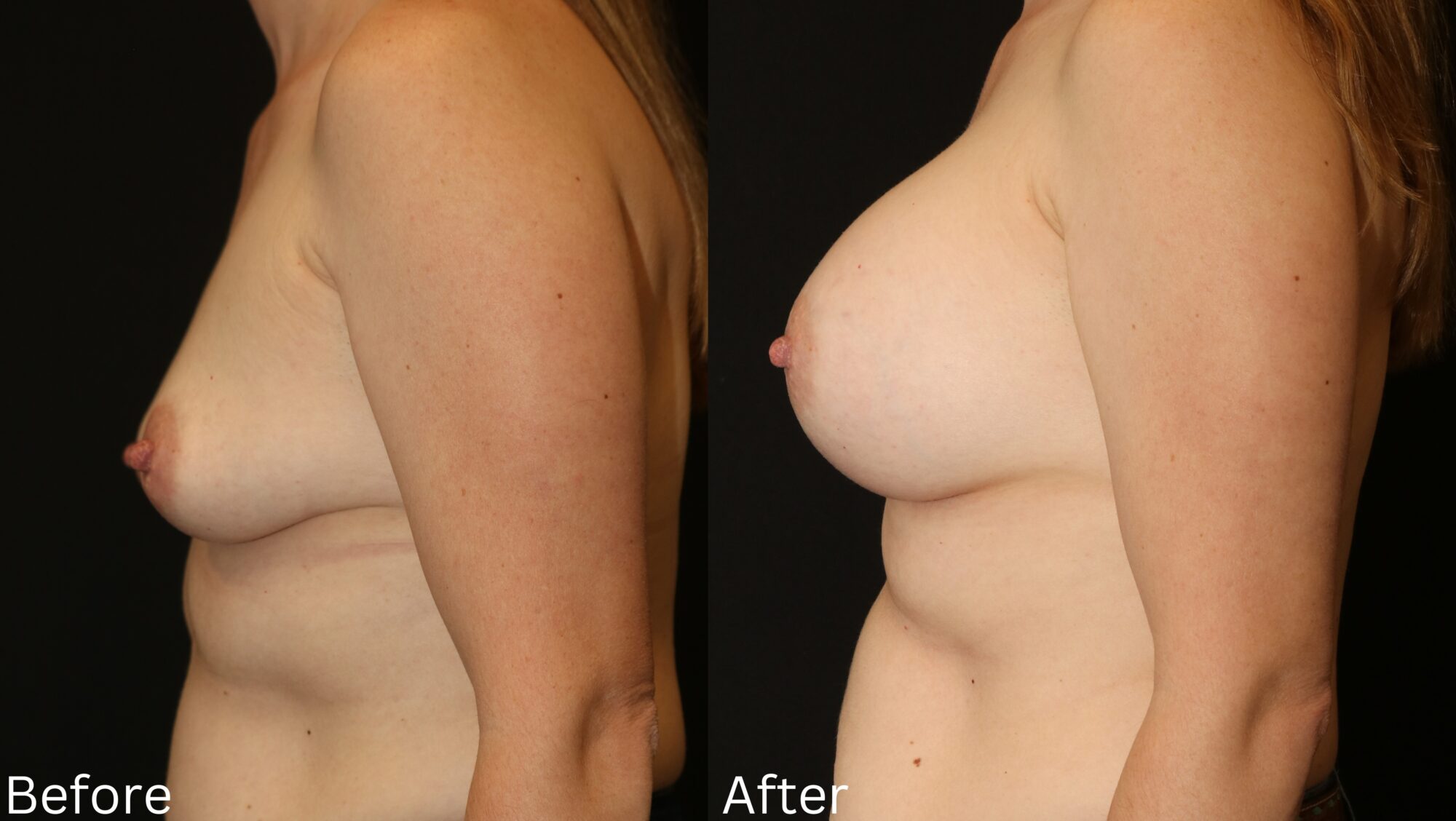 Indianapolis breast augmentation chernoff