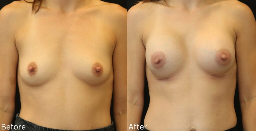 Dr. Chernoff performed a breast augmentation on this patient with small underdeveloped breasts. After photos were taken 12 months post-op. 