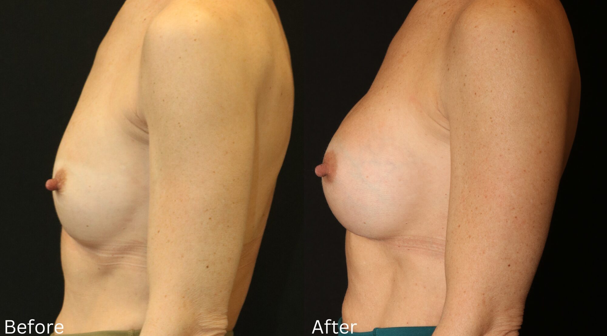 Indianapolis breast augmentation chernoff