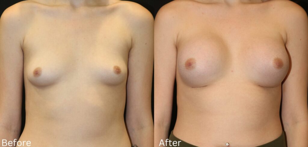 Dr. Chernoff performed a breast augmentation on this patient with small underdeveloped breasts to give the patient the desired look.   
