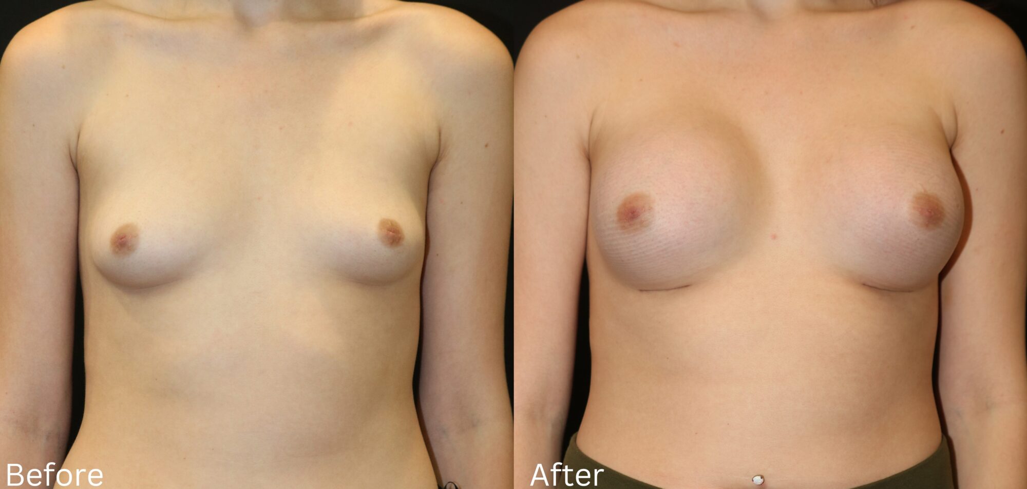 Indianapolis breast augmentation chernoff