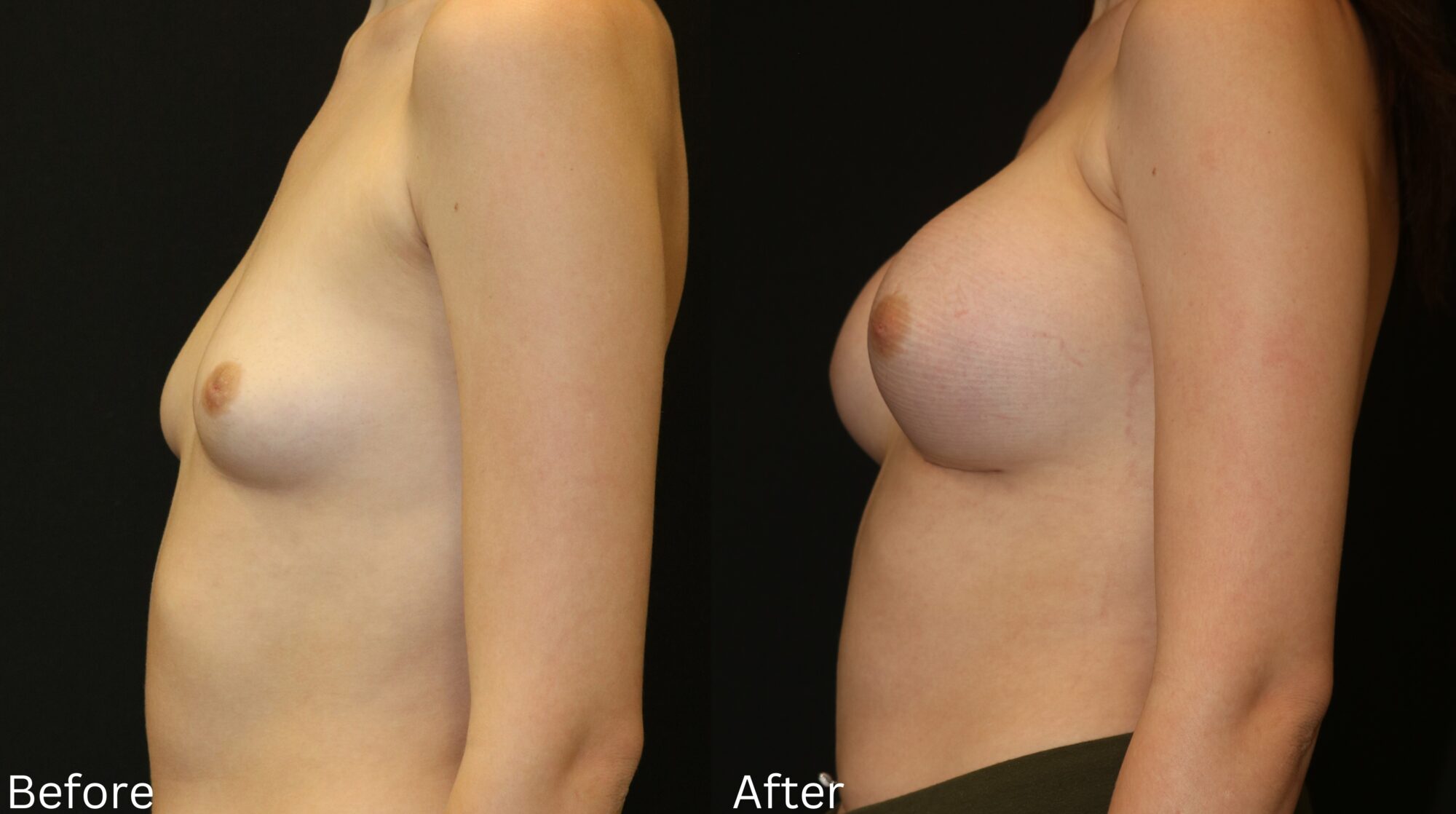 Indianapolis breast augmentation chernoff