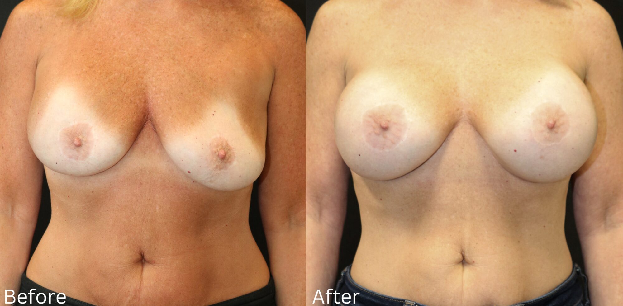 Indianapolis breast augmentation chernoff