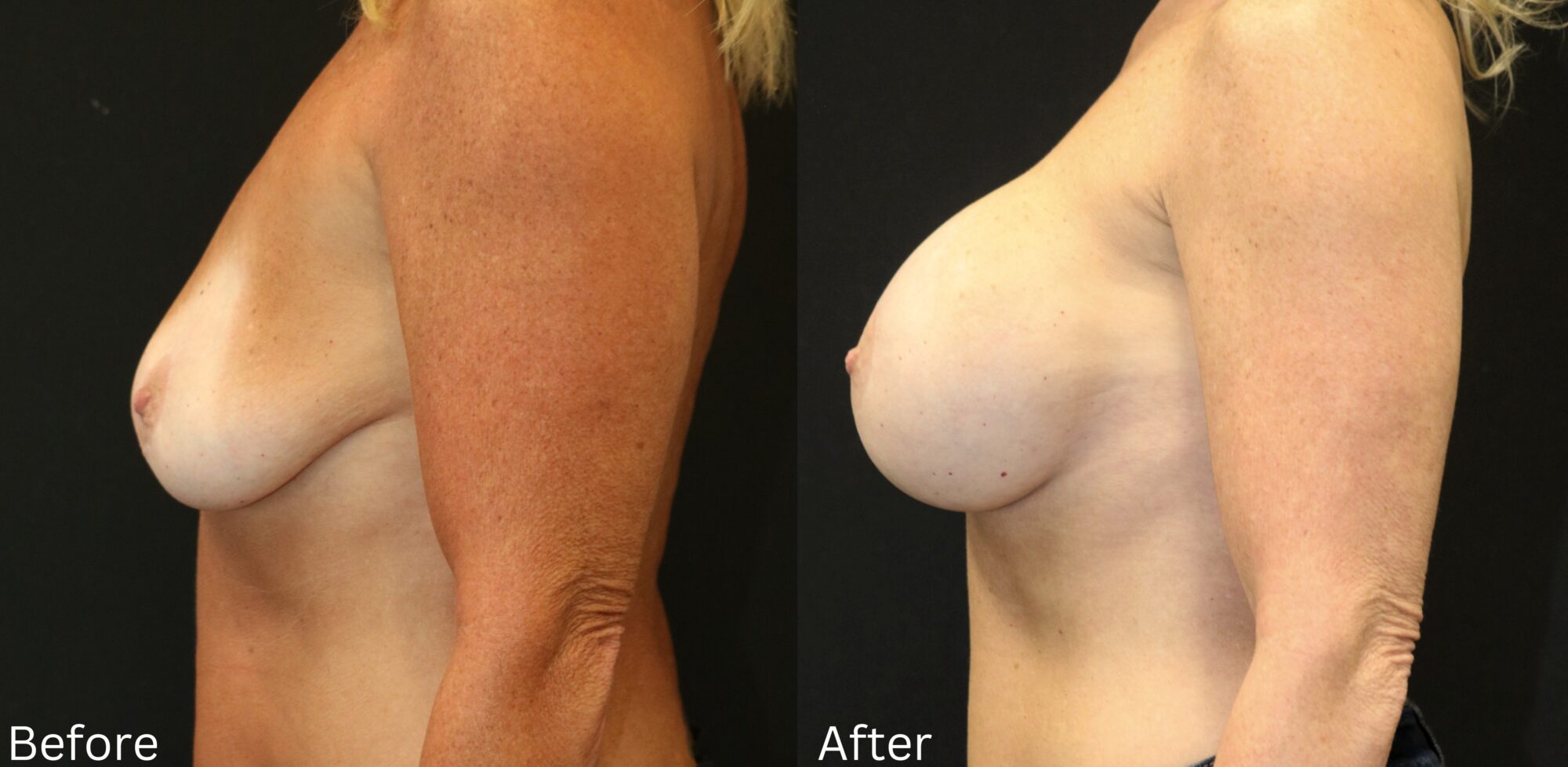 Indianapolis breast augmentation chernoff