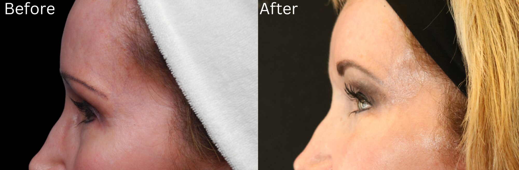Indianapolis brow lift chernoff