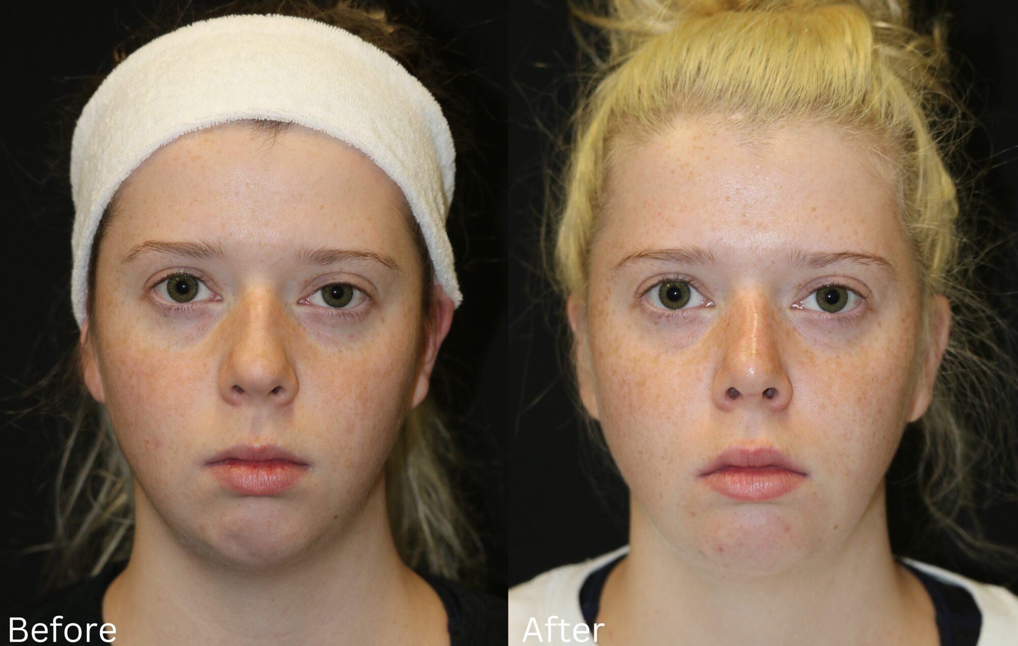 Indianapolis chin implant chernoff