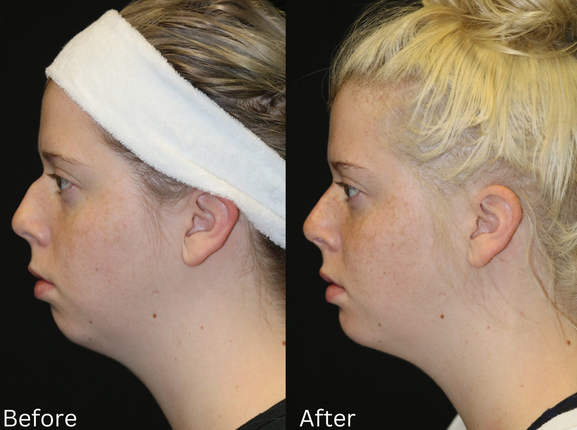 Indianapolis chin implant chernoff