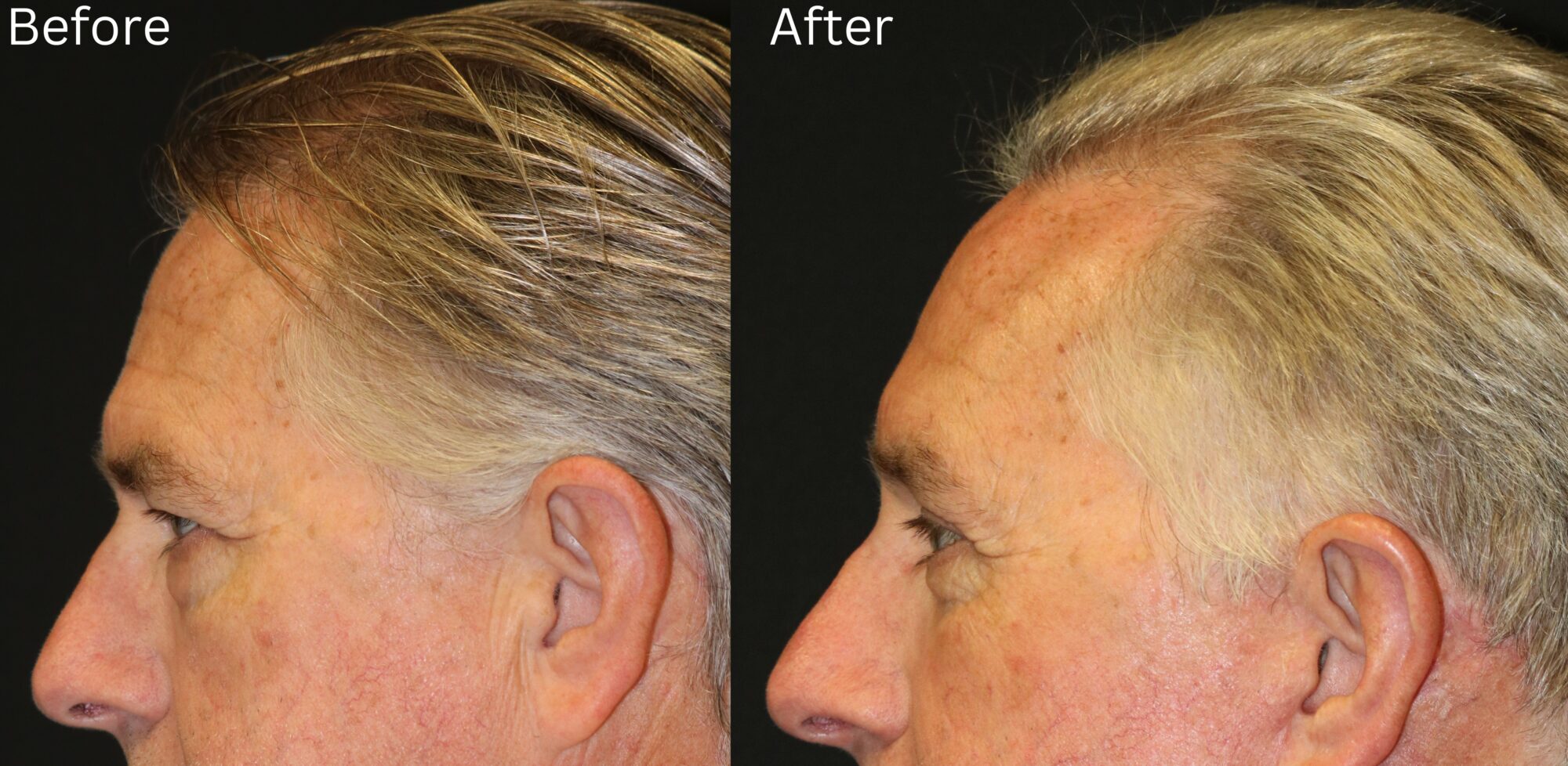 Indianapolis eyebrow lift chernoff