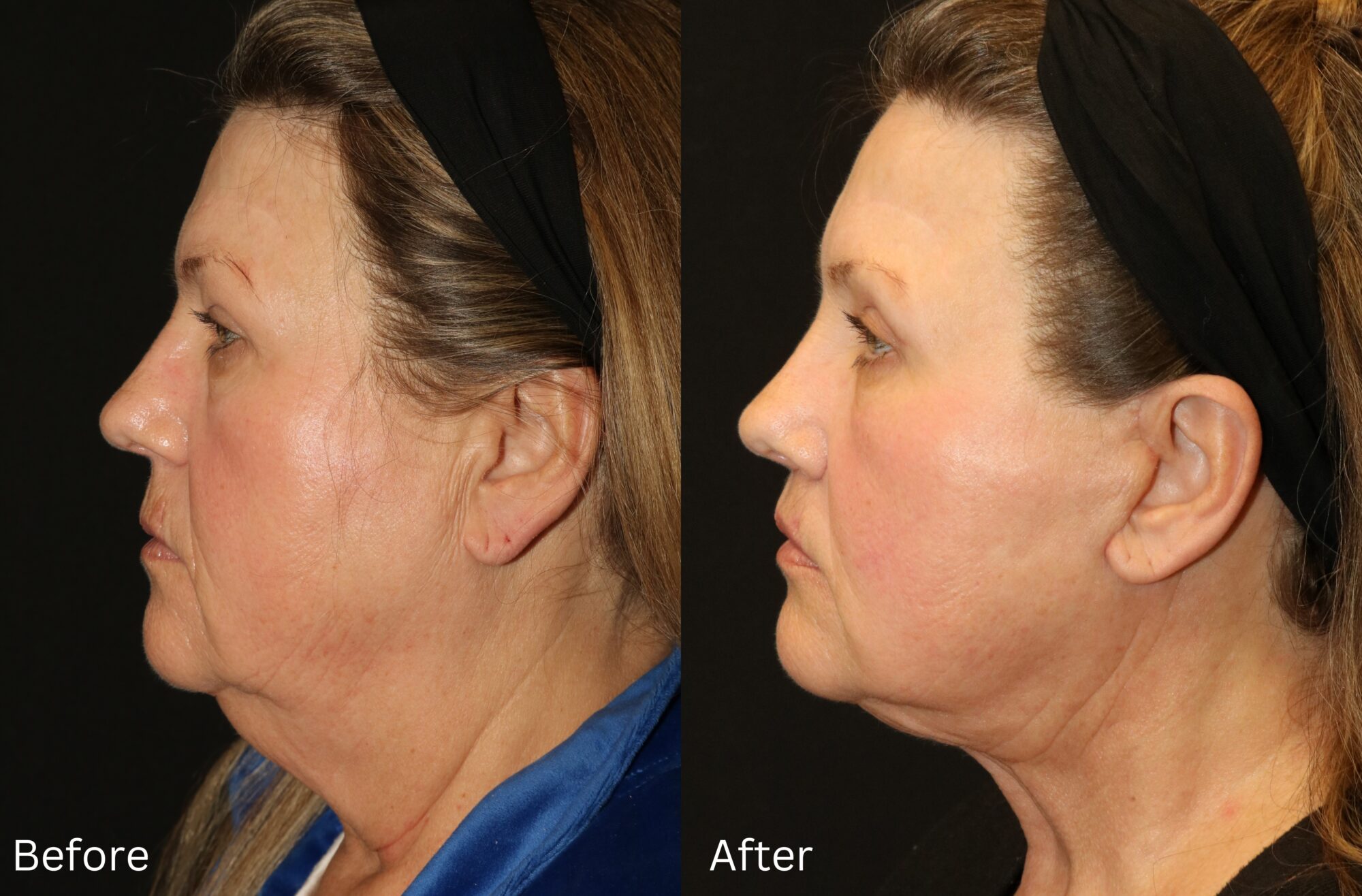 Indianapolis face neck lift chernoff