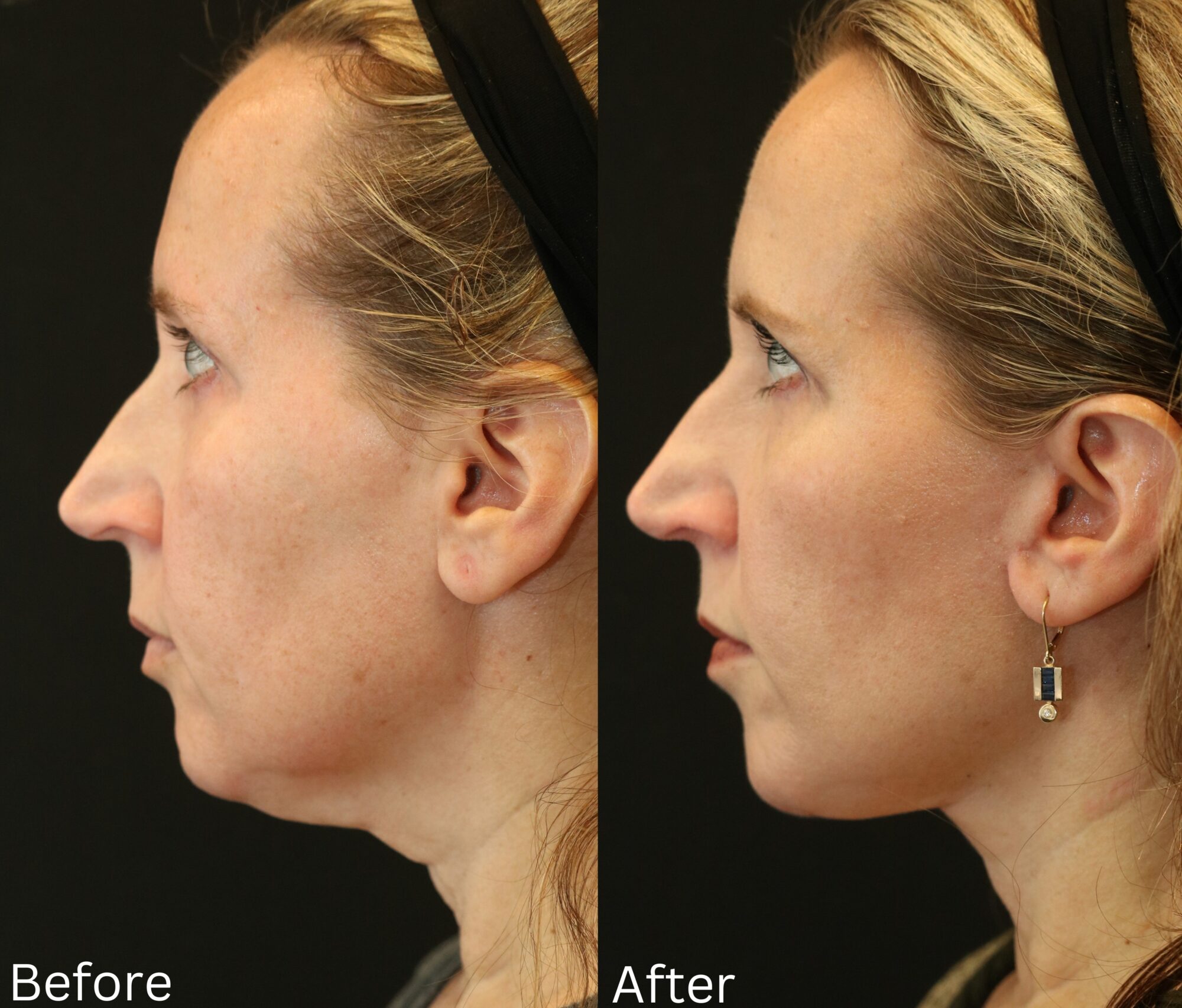 Indianapolis face neck lift chernoff