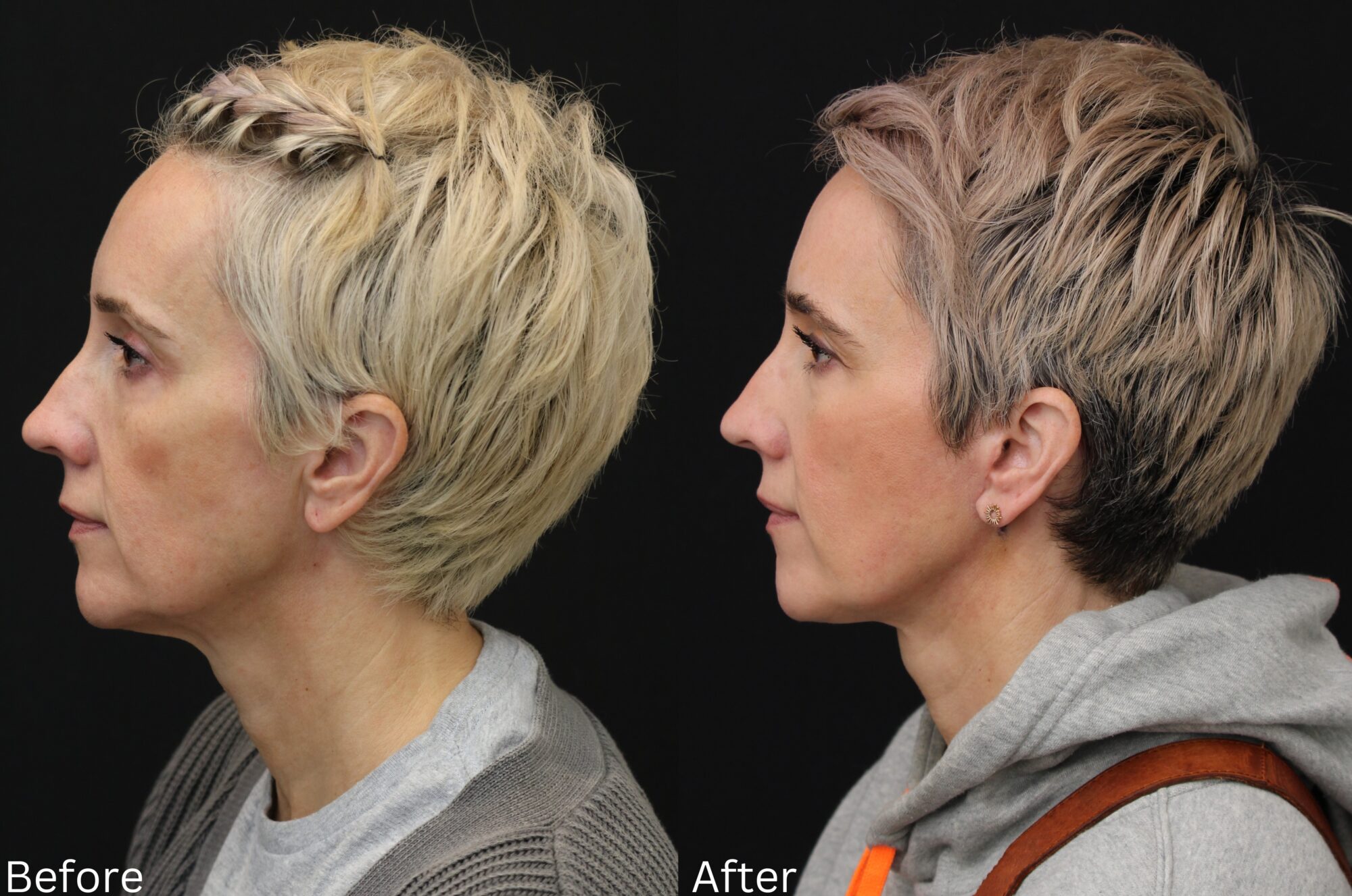 Indianapolis face neck lift chernoff