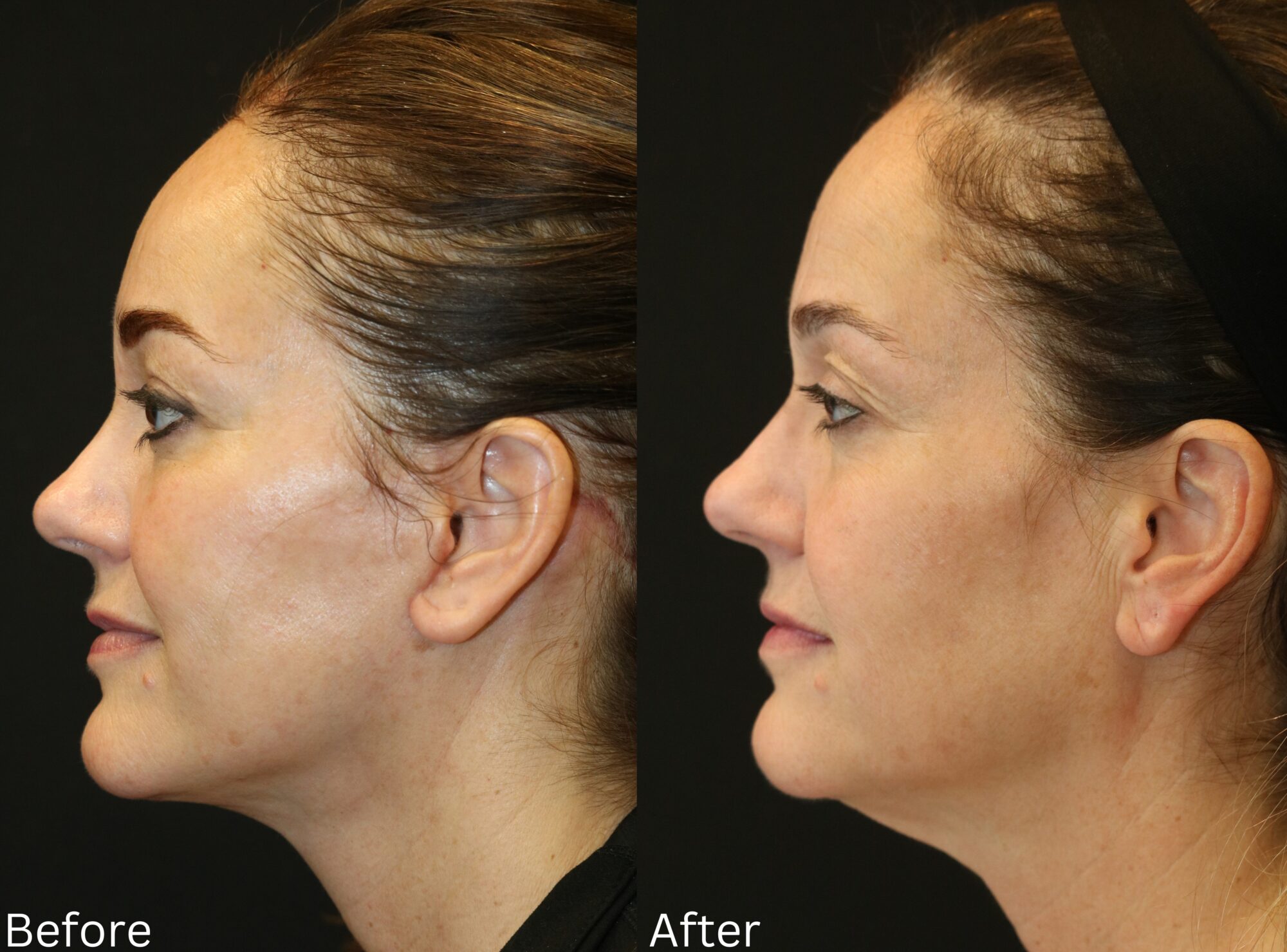 Indianapolis face neck lift chernoff