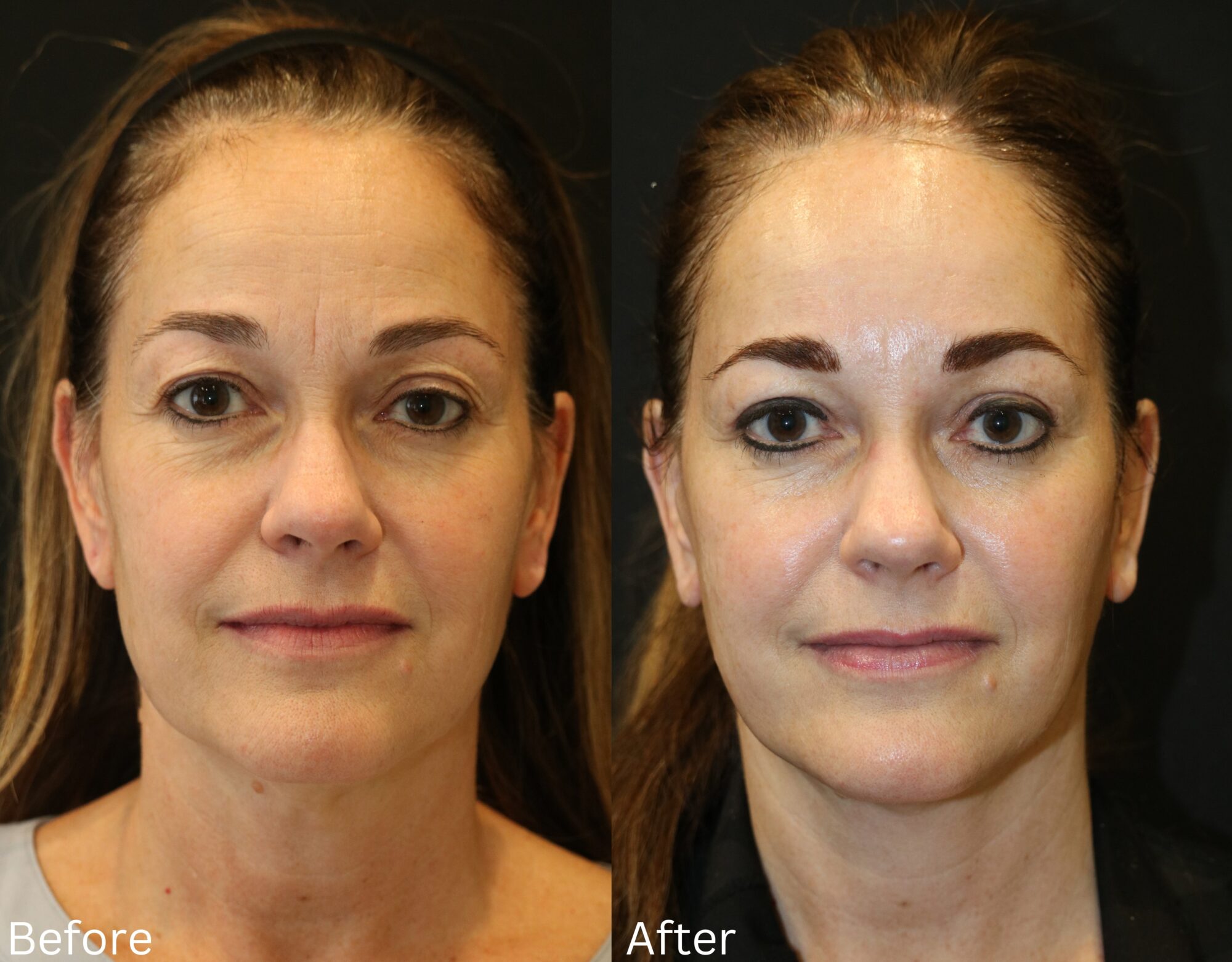 Indianapolis face neck lift chernoff