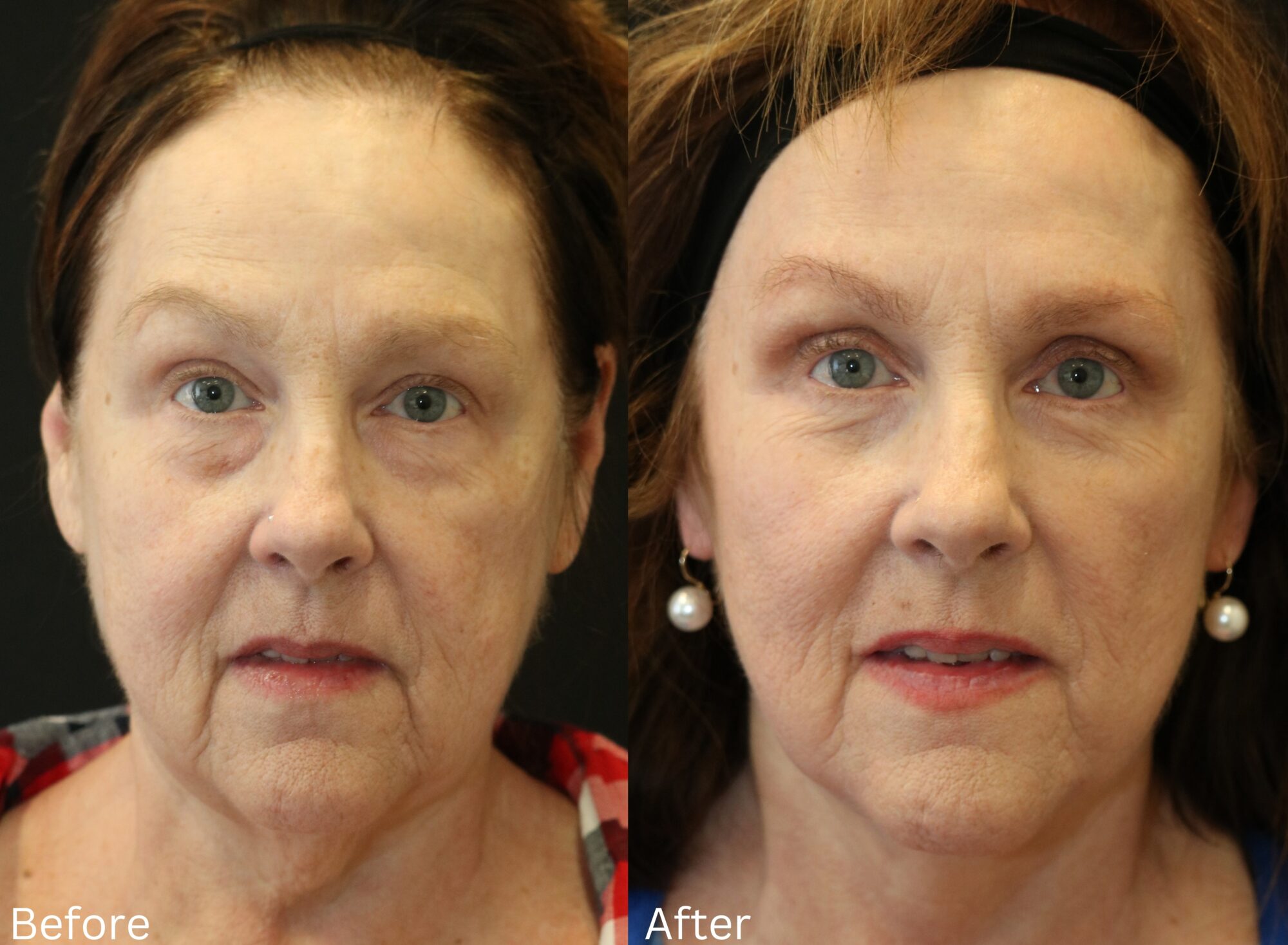 Indianapolis face neck lift chernoff