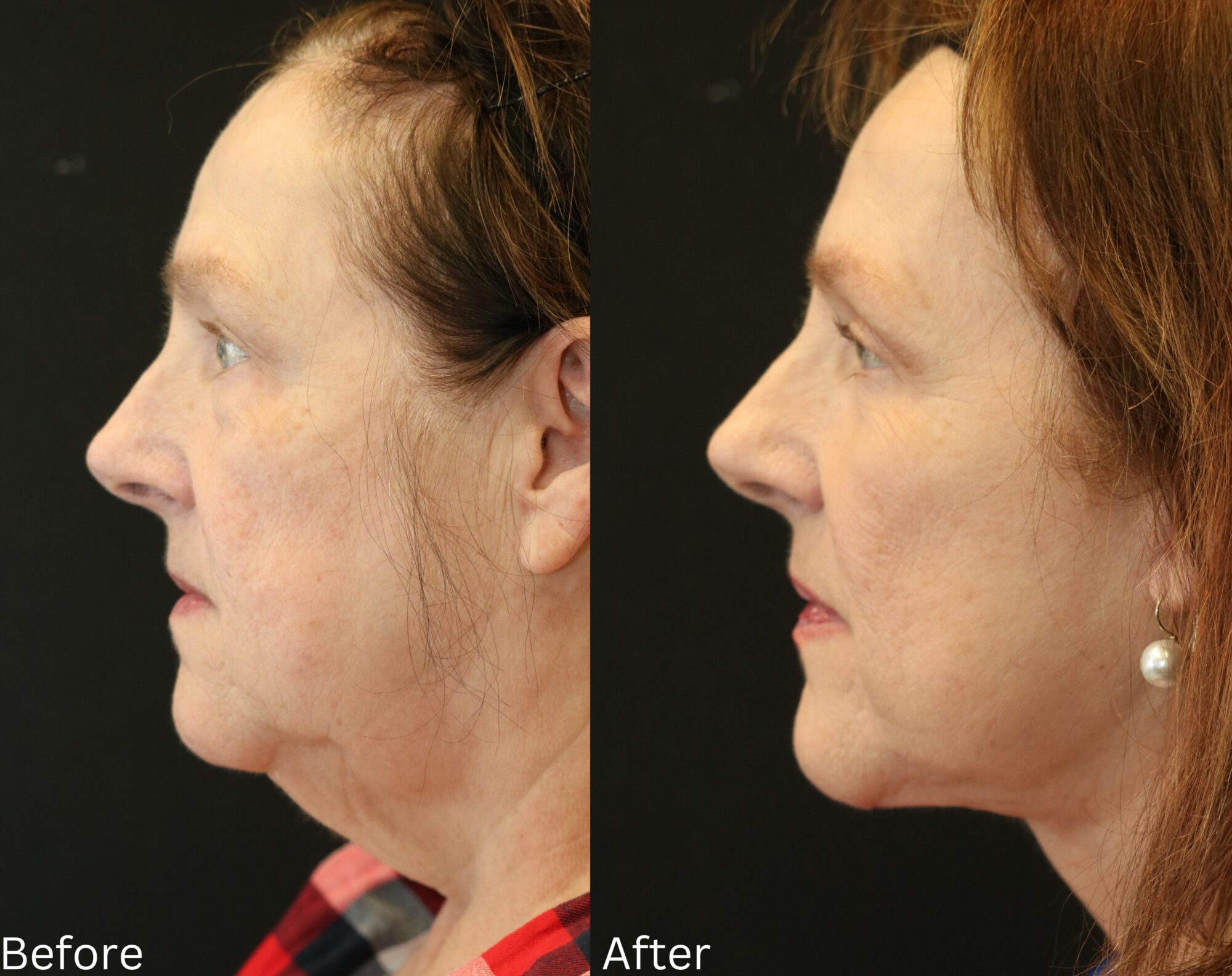 Indianapolis face neck lift chernoff