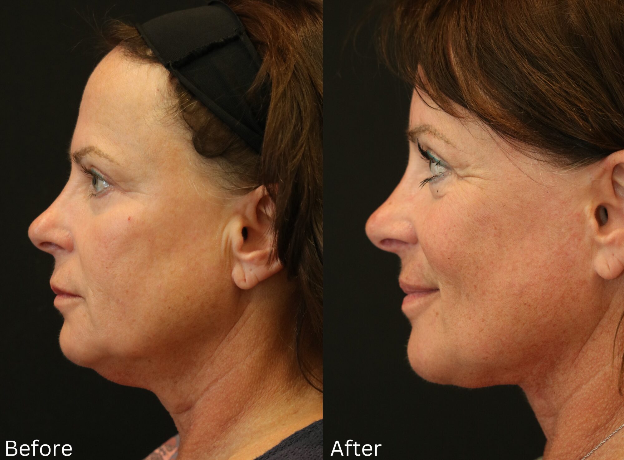 Indianapolis face neck lift chernoff