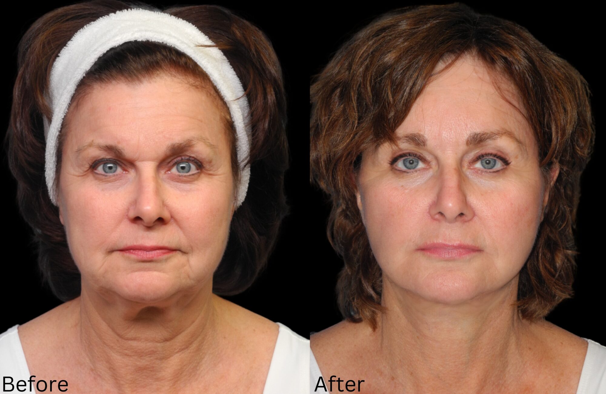 Indianapolis face neck lift chernoff