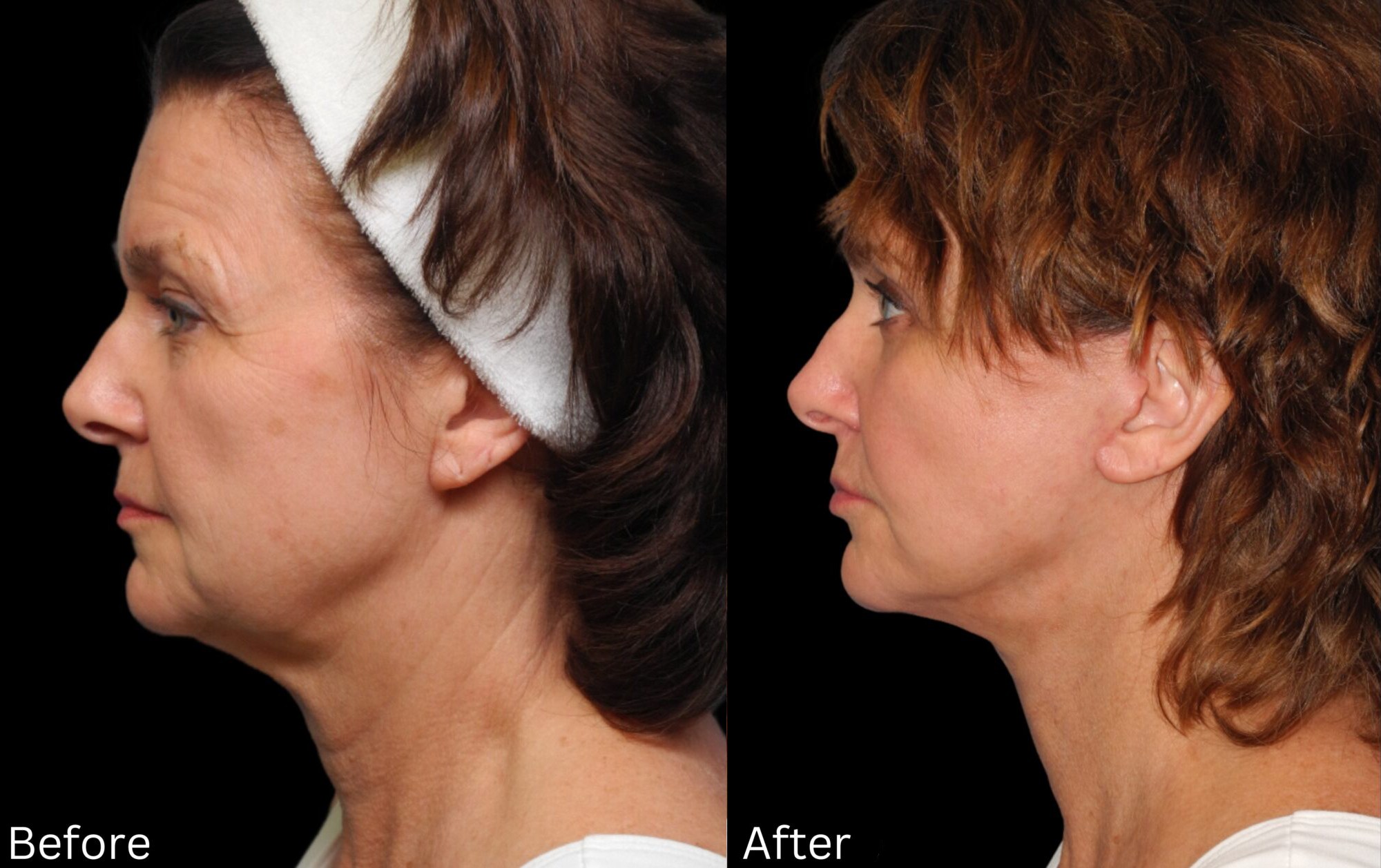 Indianapolis facial rejuvenation chernoff