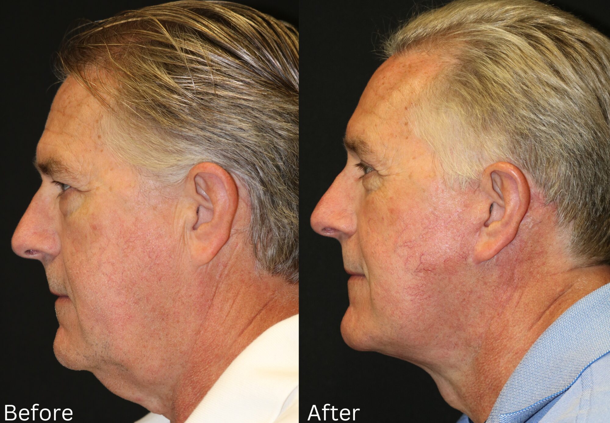Indianapolis face neck lift chernoff