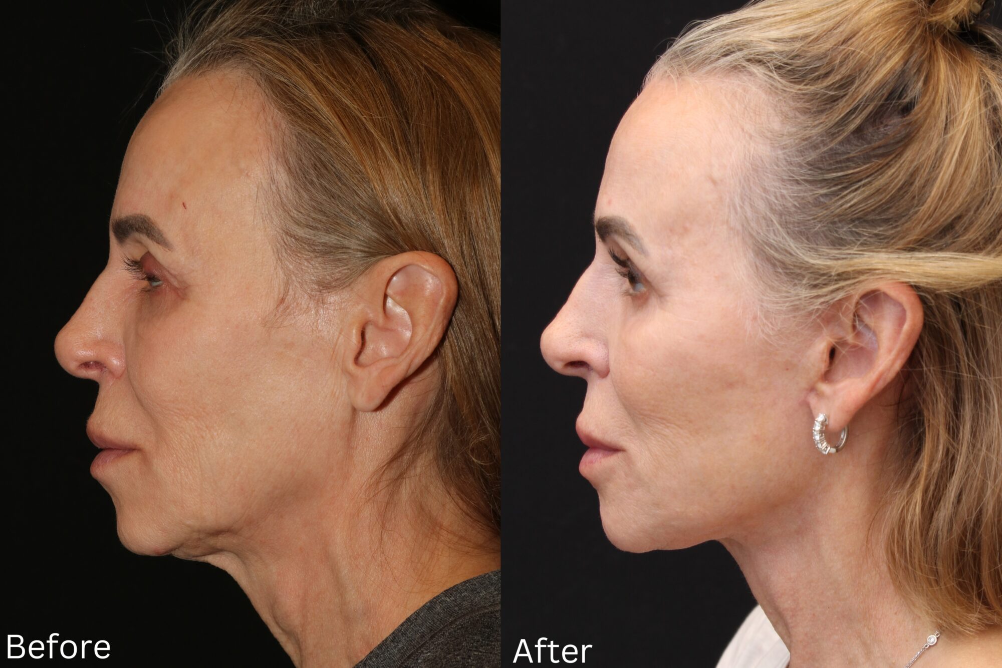 Indianapolis face neck lift chernoff