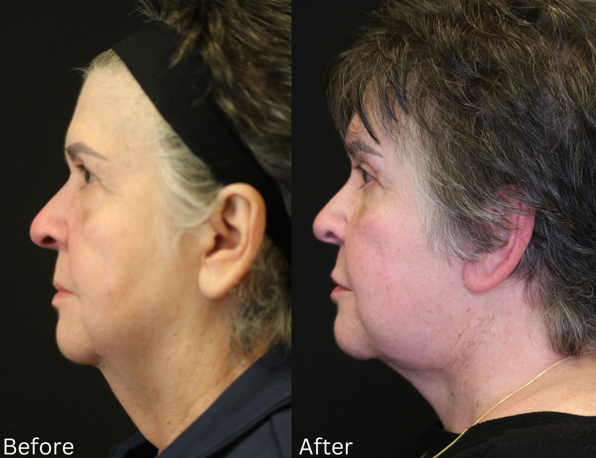Indianapolis face neck lift chernoff