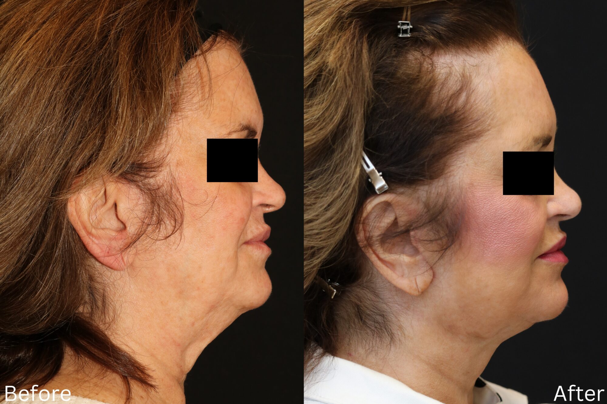 Indianapolis face neck lift chernoff