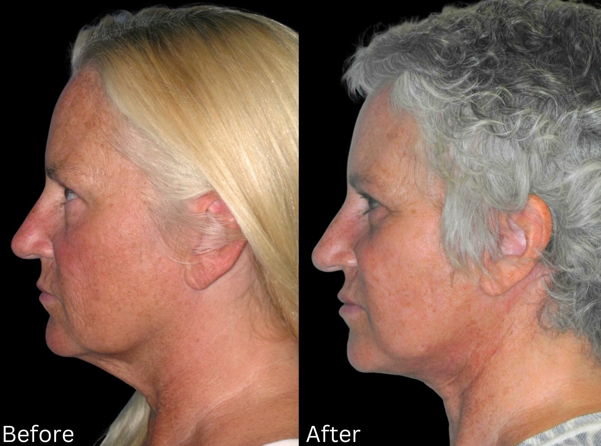 Indianapolis face neck lift chernoff