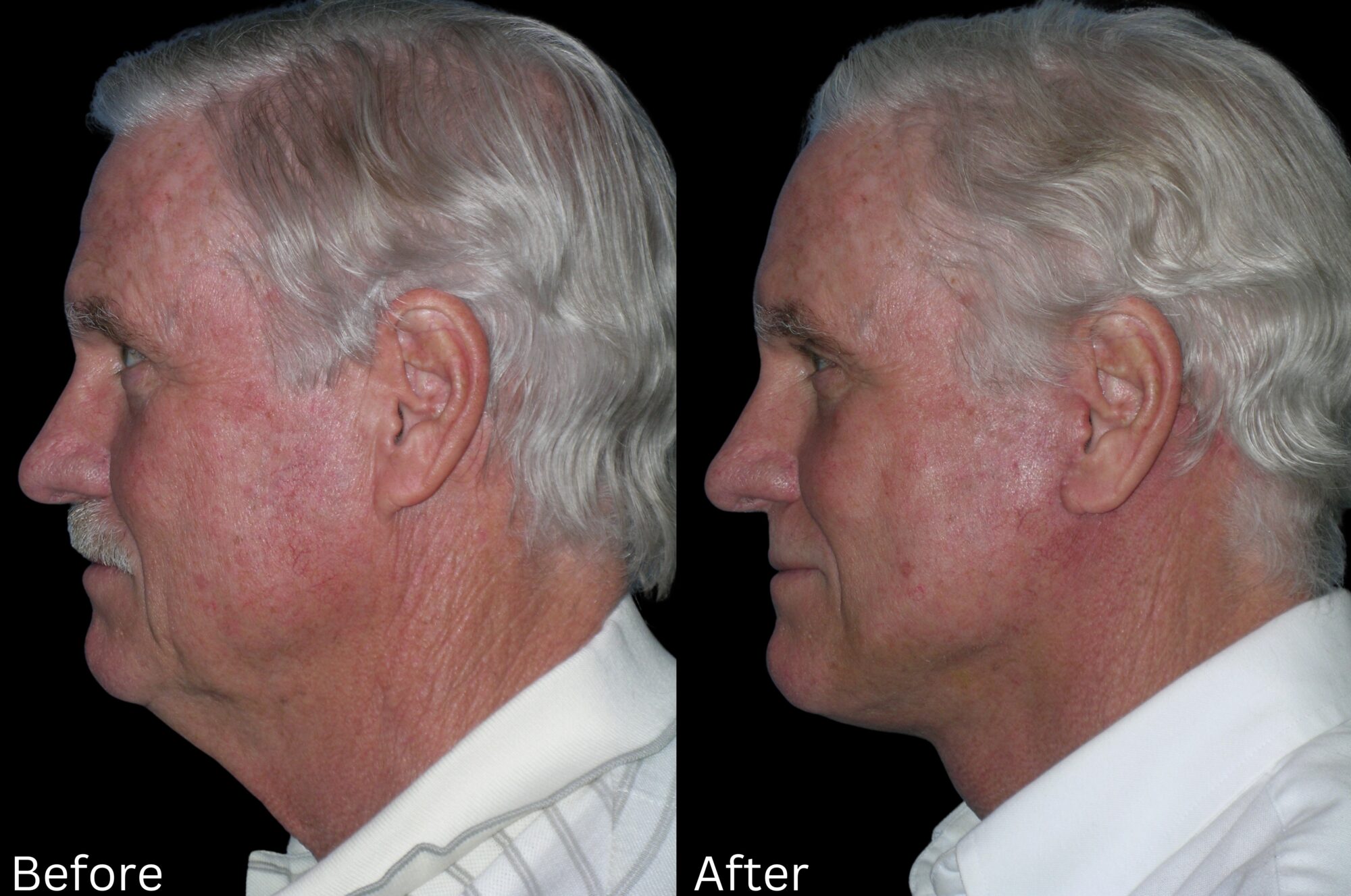 Indianapolis face neck lift chernoff
