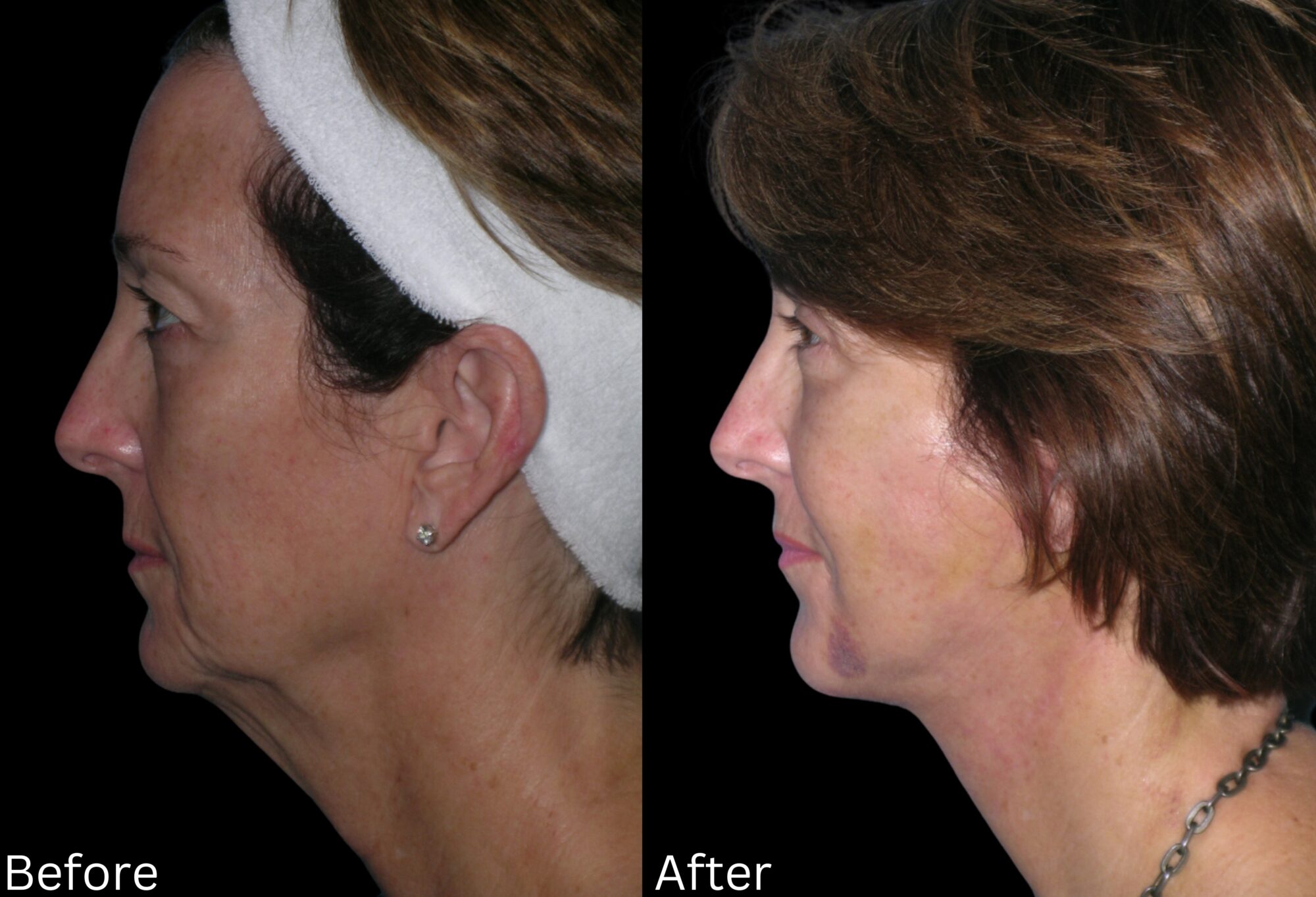 Indianapolis face neck lift chernoff